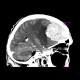 Brain tumour, meningioma: CT - Computed tomography